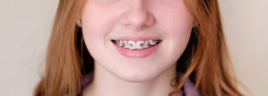 Banner beautiful caucasian young girl in dental braces smiles. Teenage concept.