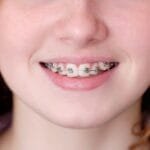 Banner beautiful caucasian young girl in dental braces smiles. Teenage concept.