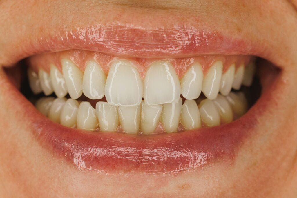 Primo piano del sorriso di una donna con denti bianchi e faccette dentali