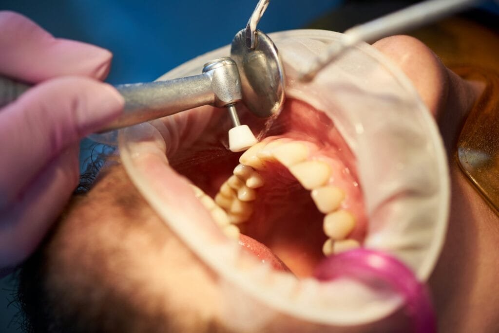 Closeup of dental treatment where teeth polished with soft dental brush and cleaned with water.