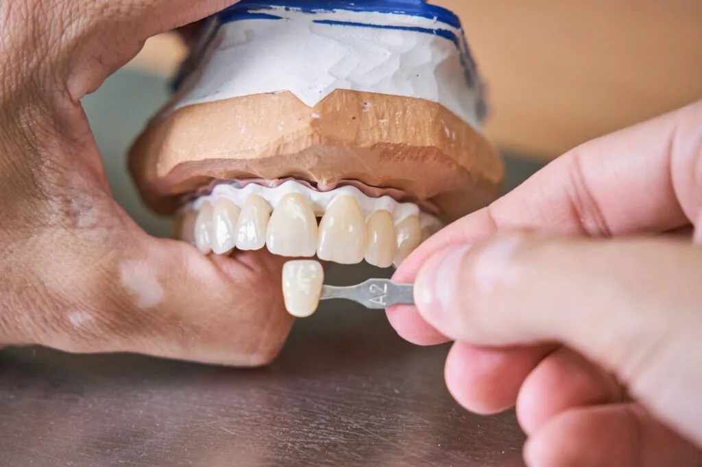 Dentista maschile durante il processo di realizzazione di faccette dentali per paziente