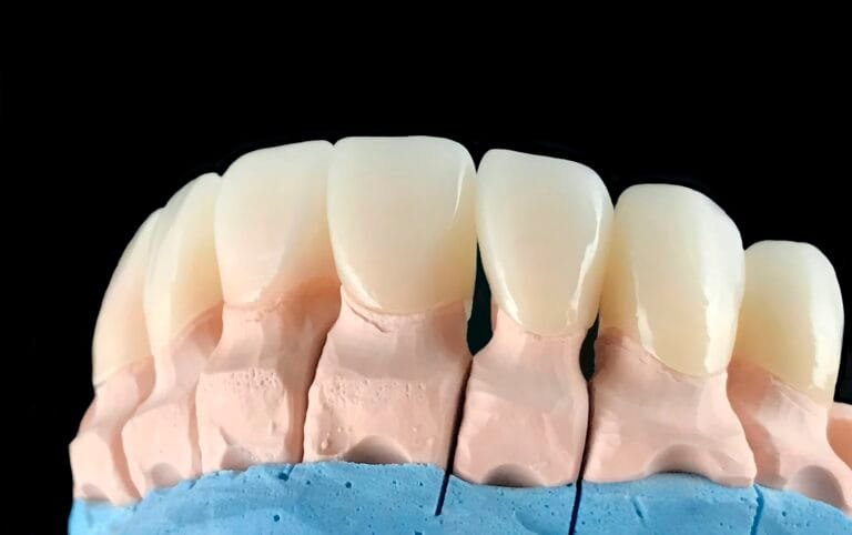 Natural look press ceramic veneers and crowns on dental plaster model. Close-up ceramic tooth crown