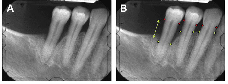 Radiografia della mascella posteriore destra con indicatori per la giunzione cemento-smalto (CEJ) e la base del difetto (BD). Altezza ossea misurata tra CEJ e BD