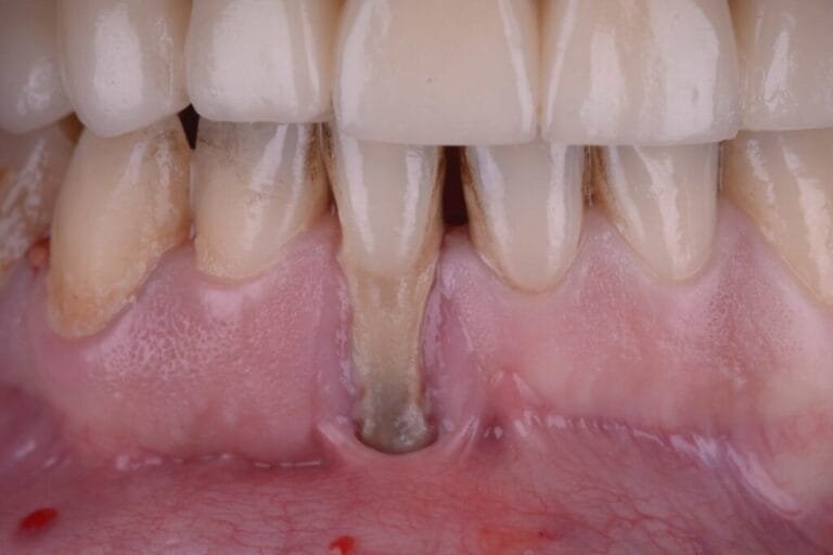 Cresta Alveolare: Struttura, Funzioni e Importanza