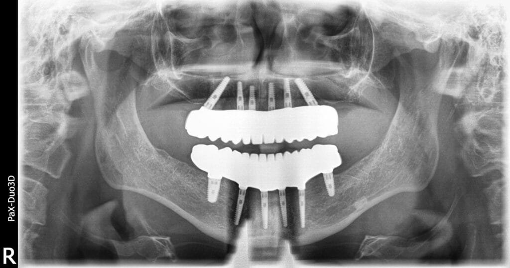 Panoramica dentale X-ray con protesi fissa in entrambe le mascelle con metodo All-on-6