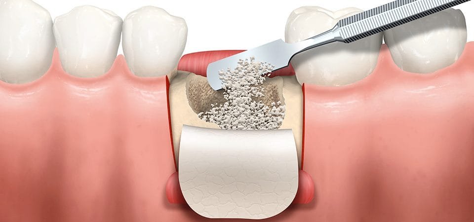 Illustrazione di un innesto osseo dentale sulla cresta alveolare con osso artificiale per supporto del dente